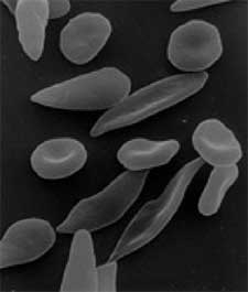 red_and_sickle_cells